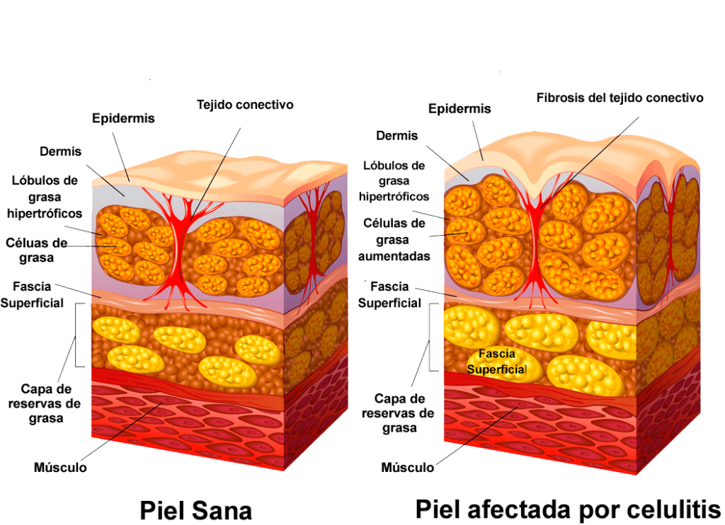 celulas celulitis