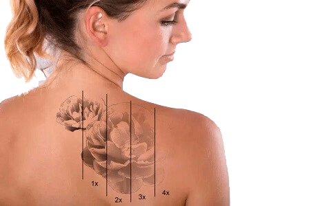 Eliminacion de tatuajes