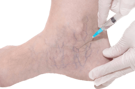 escleroterapia arañas vasculares