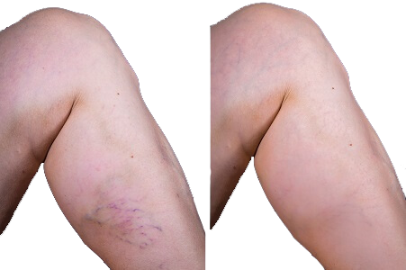 laser arañas vasculares antes y despues