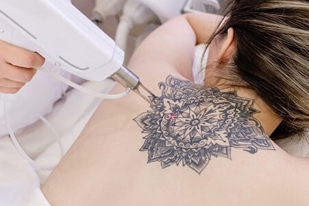 quitar tatuaje laser