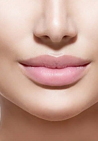 Labios Hialuronico despues