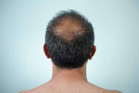 Prp capilar alopecia-masculina