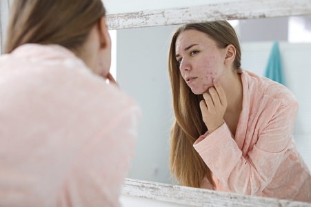 acne en la cara