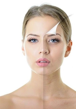 antes y despues acne