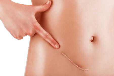 eliminar cicatrices abdomen precio