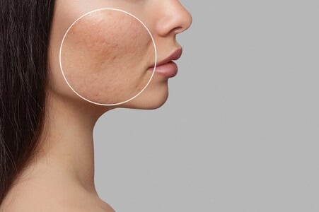 eliminar cicatrices de acne