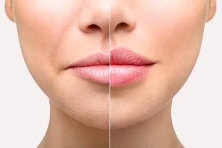 labios-acido-hialuronico-antes-y-despues