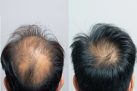 plasma capilar antes y despues