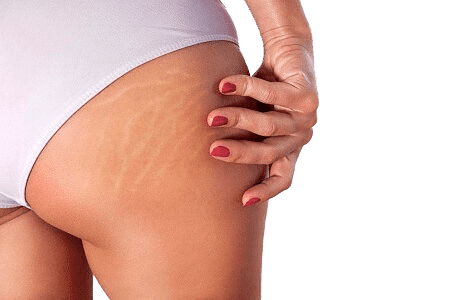 quitar estrias gluteos precio