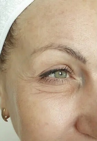 Quitar-manchas-en-la-piel-con-laser-antes