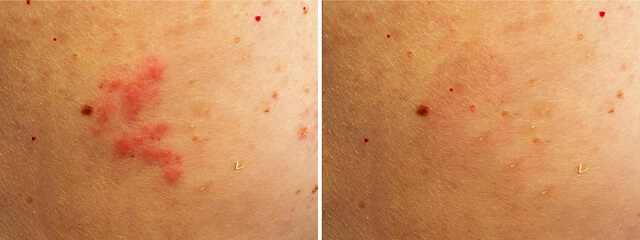 eliminar melasma antes y después