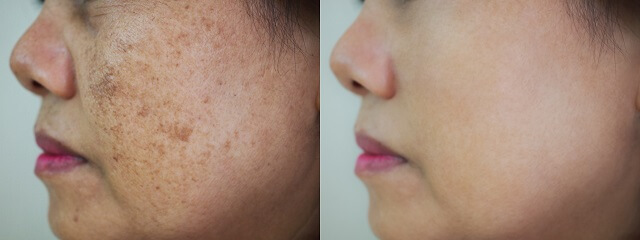 quitar melasma antes y despues