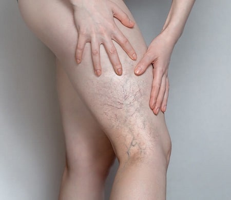arañas vasculares piernas