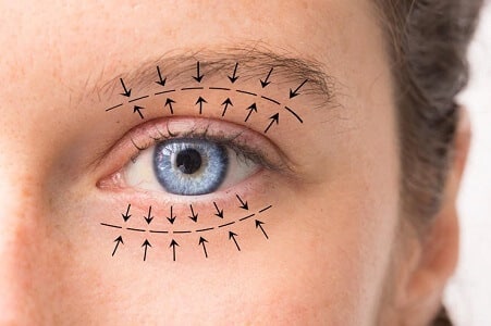 blefaroplastia levantar parpados