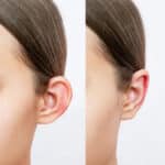 otoplastia antes y despues