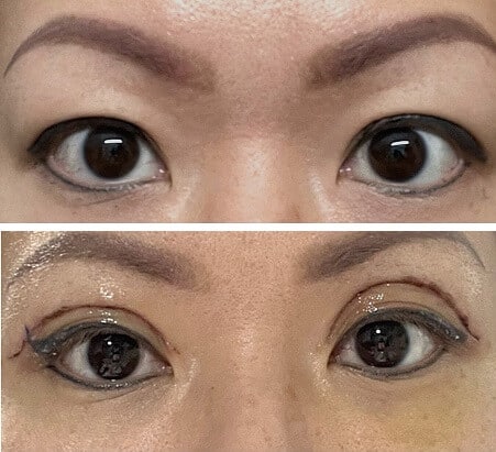 Blefaroplastia superior madrid