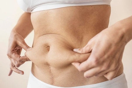 abdominoplastia madrid