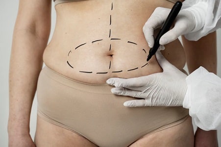 abdominoplastia precio