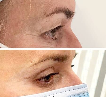 blefaroplastia inferior