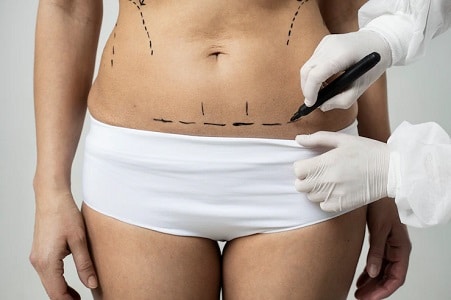 miniabdominoplastia