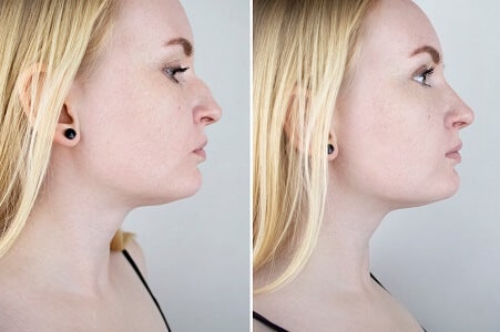 operacion de nariz antes y despues