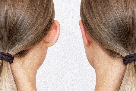 operacion de orejas antes y despues