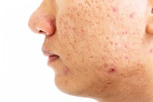 eliminar cicatrices de acne precio