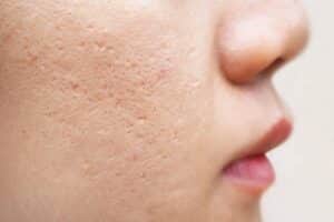 quitar cicatriz acne madrid