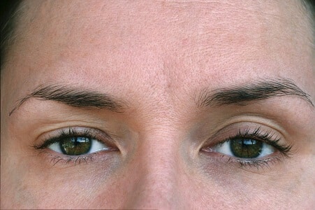 cirugia Ptosis palpebral madrid