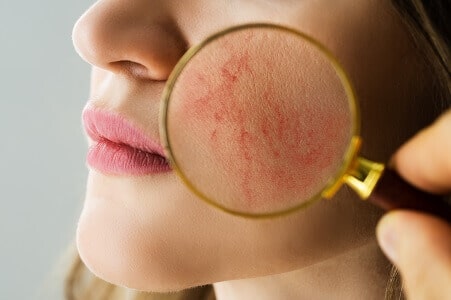 Tratamiento para la rosacea Madrid