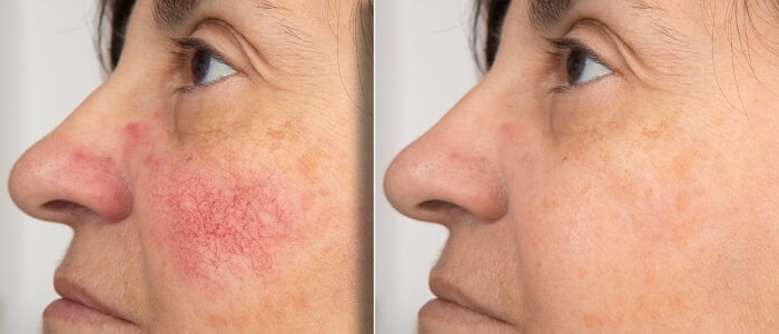 Tratamiento para la rosacea antes y despues