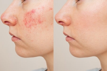quitar la rosacea en la cara