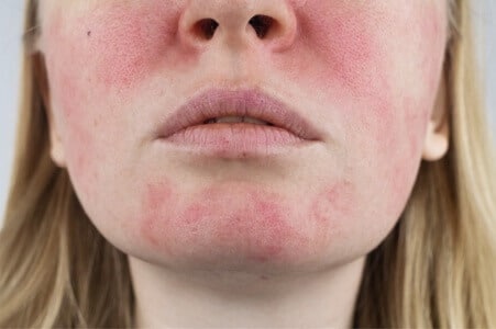 quitar rosacea precio madrid