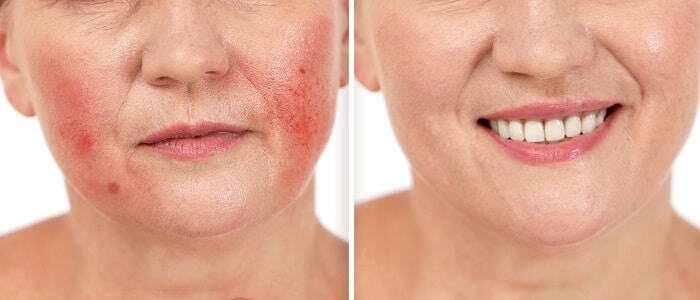 rosacea antes y despues