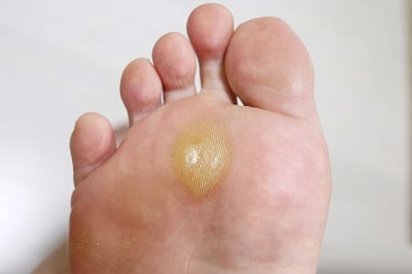 callosidades en los pies