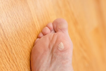 como prevenir los callos en los pies