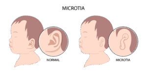 oreja tipo microtia