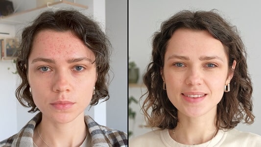 laser co2 antes y despues