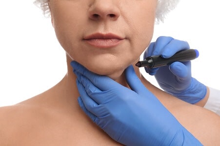 lipolisis laser precio