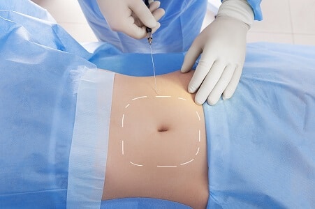 lipolisis abdominal madrid precio